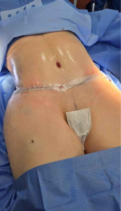Cirugía de Abdominoplastia en Clínica Danas
