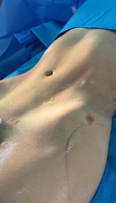 Cirugía de Lipoescultura en Clínica Danas