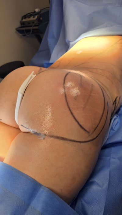 Cirugía de Lipoescultura en Clínica Danas